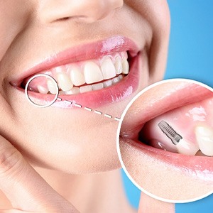 A photo highlighting a woman’s completed dental implant
