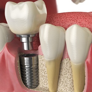 A 3D illustration of a single dental implant and crown