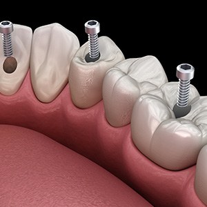 A 3D illustration of an implant bridge and its parts