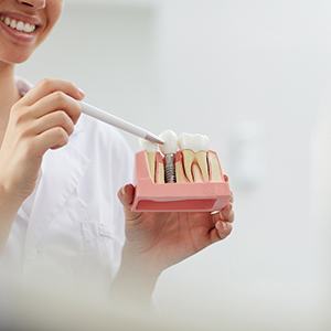 A model of dental implant osseointegration