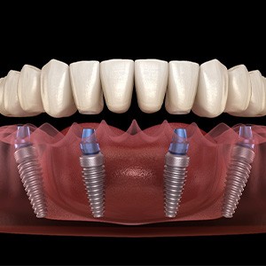 A 3D illustration of an implant denture and its parts