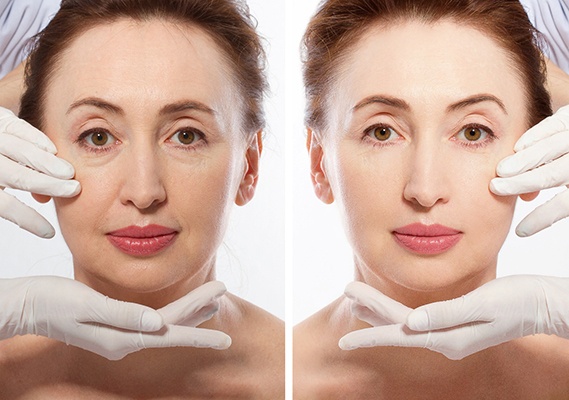 Before and after image of woman who received BOTOX