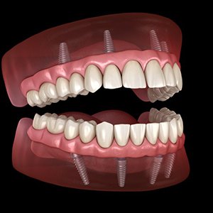 Illustration of implant dentures in gum tissue
