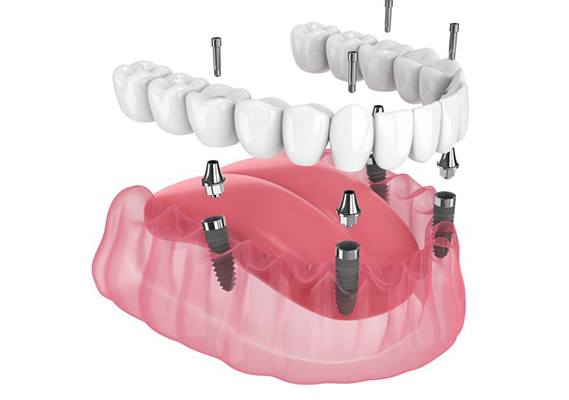 Illustration of fixed implant dentures