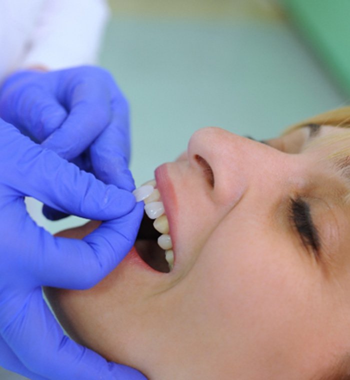 a dentist placing a veneer over a patient’s tooth