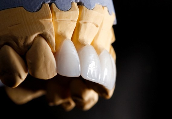 a plaster model of a mouth with veneers placed over the teeth